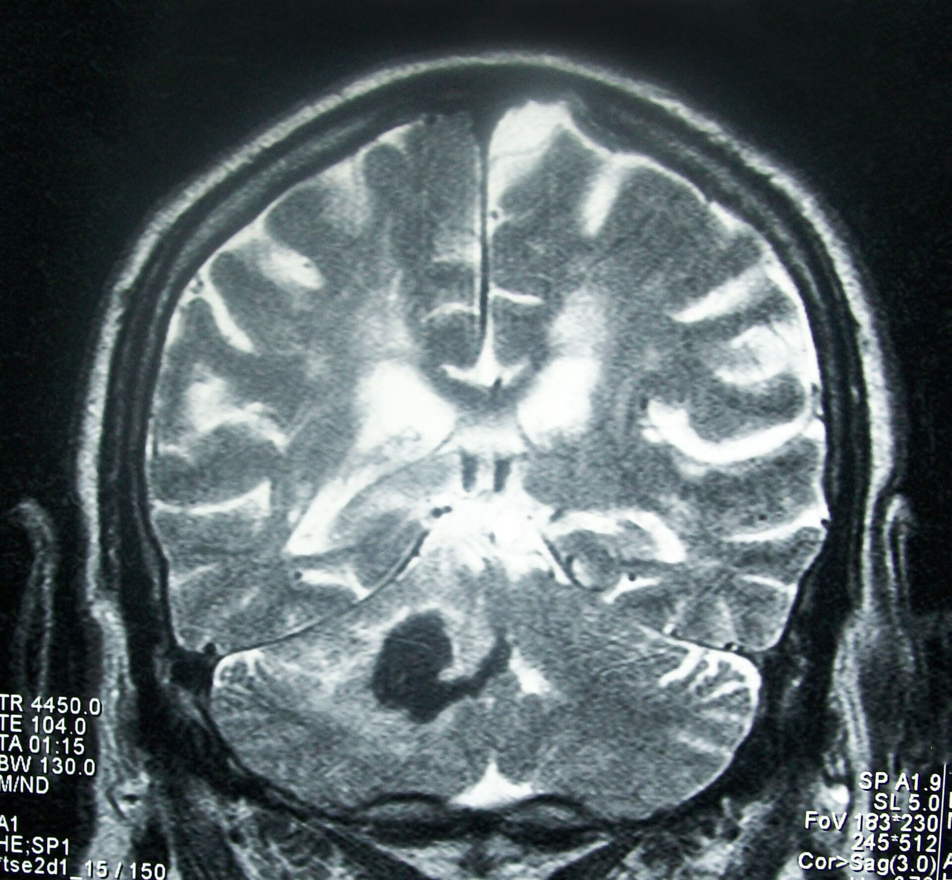 Una hemorragia cerebral, imagen referencial - Sputnik Mundo, 1920, 11.02.2021