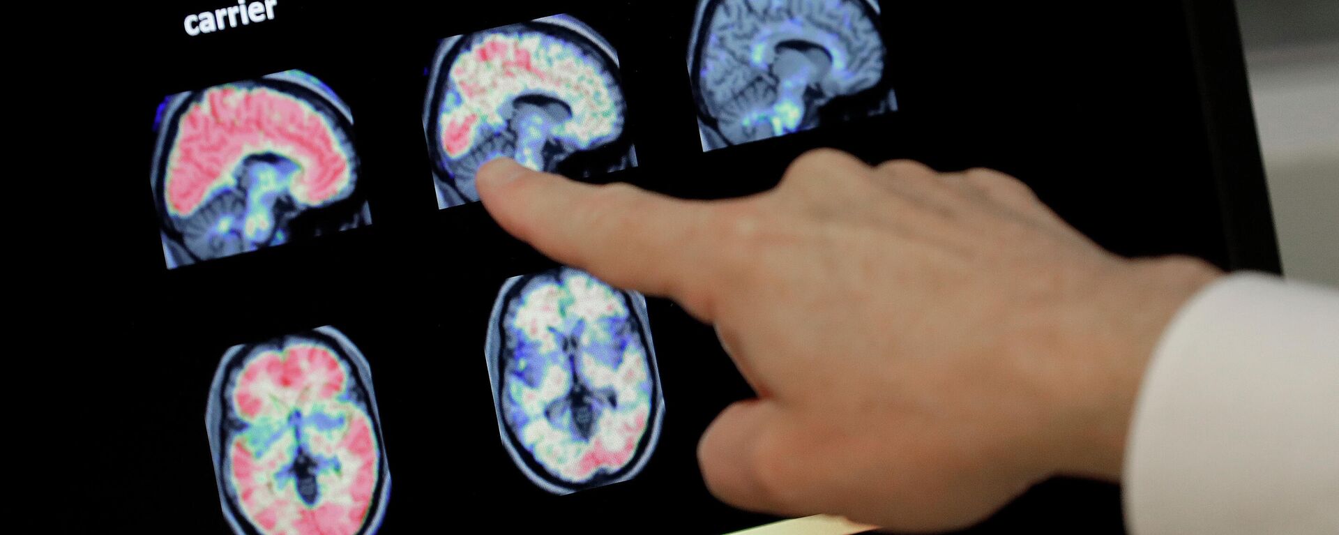 En esta foto de archivo del 14 de agosto de 2018, un médico observa una tomografía computarizada de un cerebro.  - Sputnik Mundo, 1920, 08.06.2021