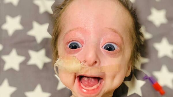 Vito, bebé argentino con progeria - Sputnik Mundo