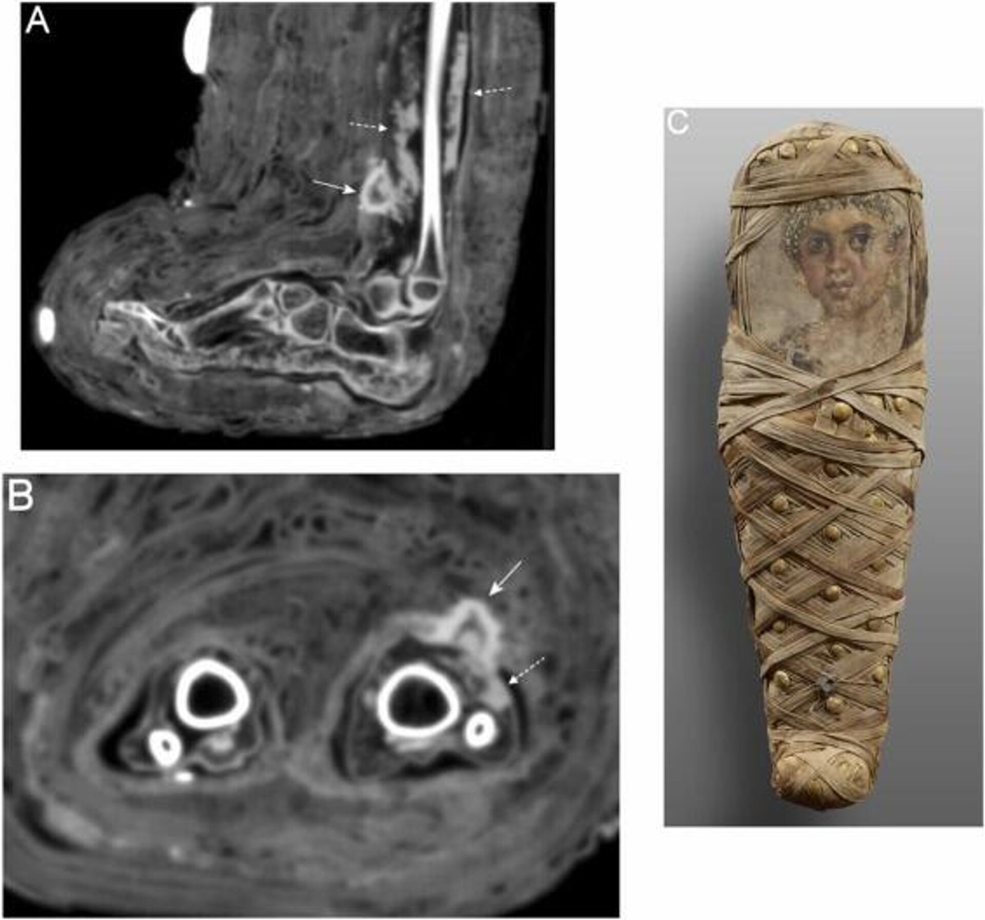 Dos tomografías donde se observa el área de la herida en la pierna izquierda de la momia - Sputnik Mundo, 1920, 22.01.2022