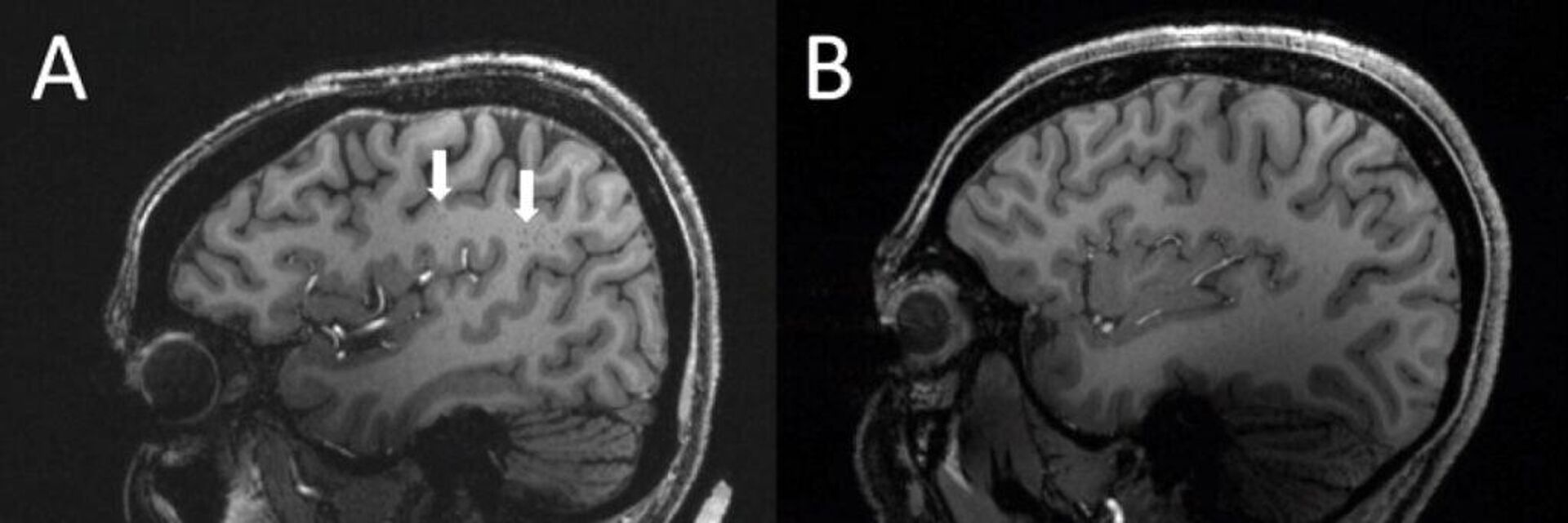 La IRM del cerebro de un paciente con migraña (izquierda) y de un participante del grupo de control (derecha). Las flechas muestran la zona del centro semioval con espacios perivasculares agrandados - Sputnik Mundo, 1920, 22.12.2022