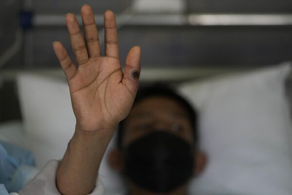Un paciente muestra la llaga que produjo en su mano la viruela del mono en el Hospital Arzobispo Loayza de Lima, Perú, el 16 de agosto.  - Sputnik Mundo