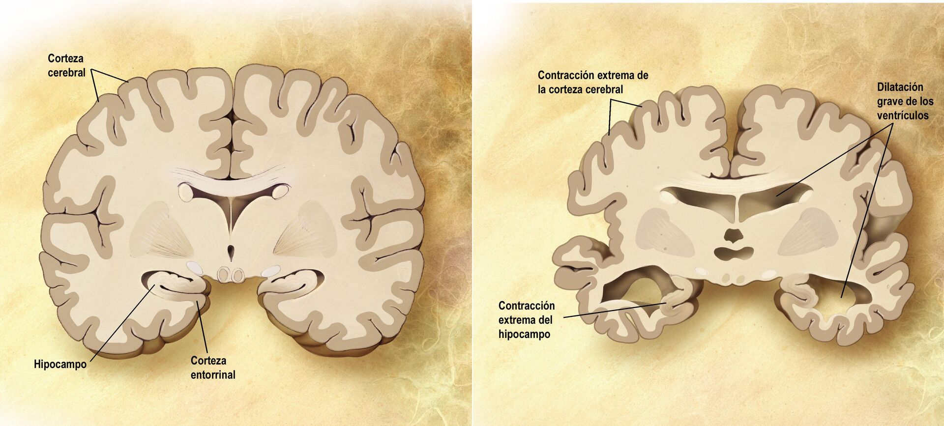 Imagen del cerebro normal y del cerebro en la enfermedad de Alzheimer - Sputnik Mundo, 1920, 15.05.2023