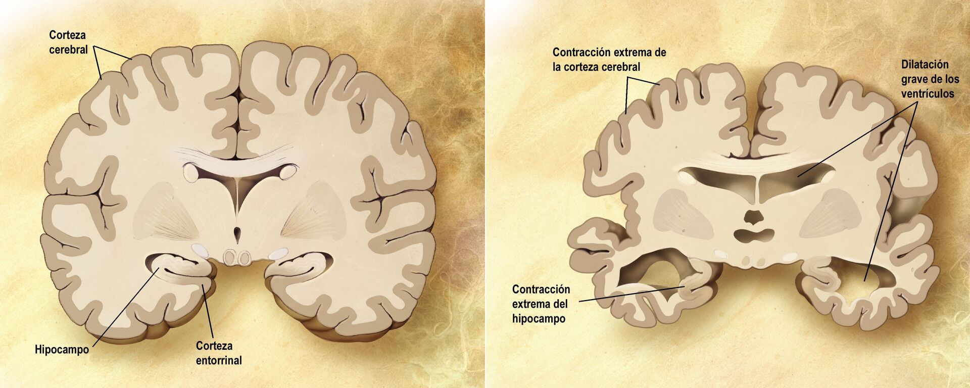 Imagen del cerebro normal y del cerebro en la enfermedad de Alzheimer - Sputnik Mundo, 1920, 04.09.2023