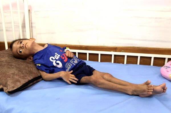 Yousef Adham, niño paralizado y con el cerebro atrofiado - Sputnik Mundo