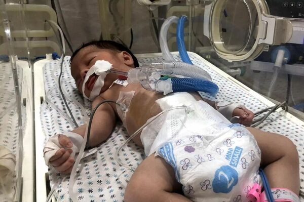 Niño gazatí que sufre desnutrición aguda - Sputnik Mundo