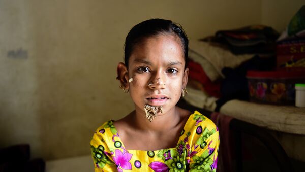 In this photograph taken on January 30, 2017, Bangladeshi patient Sahana Khatun, 10, poses for a photograph at the Dhaka Medical College and Hospital. - Sputnik Mundo