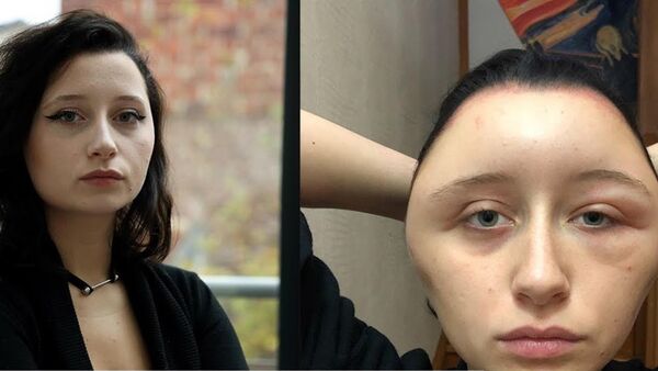 A una joven se le desfigura el rostro después de teñirse el pelo - Sputnik Mundo
