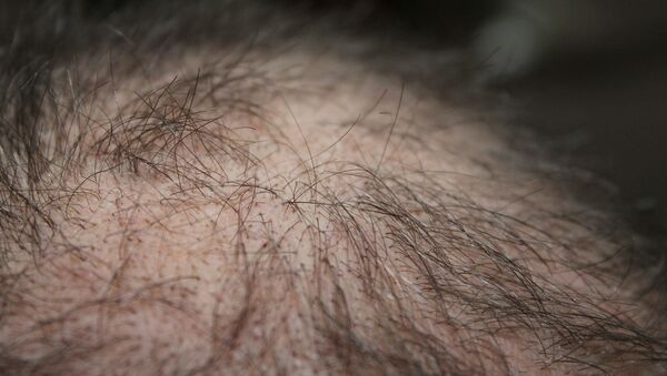 Calvo. Calvicie. Alopecia. Imagen referencial - Sputnik Mundo