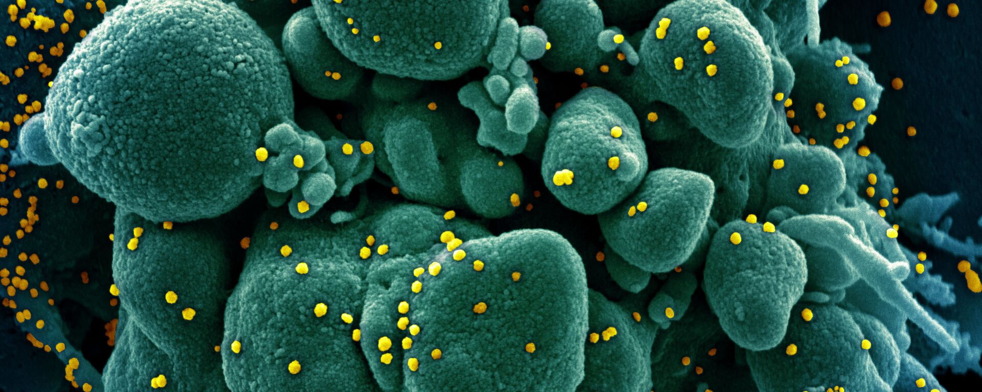 Micrografía electrónica coloreada de una célula humana (azul-verde) infectada por el virus SARS-COV-2 (amarillo) - Sputnik Mundo, 1920, 15.01.2021