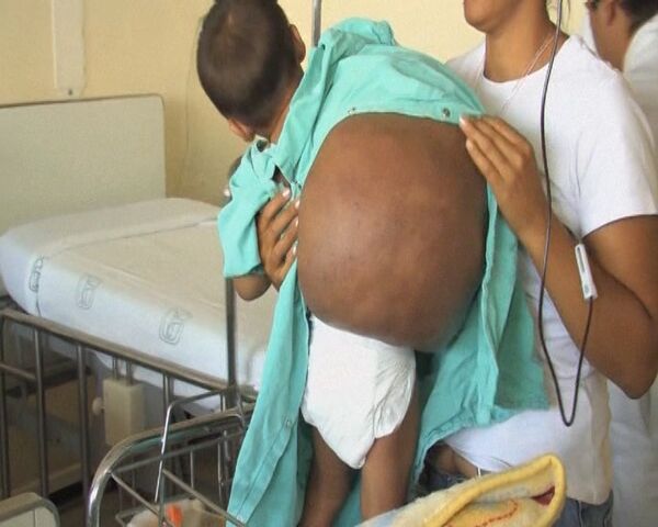 Médicos mexicanos extirpan un tumor de 15 kilogramos a niño de dos años  - Sputnik Mundo